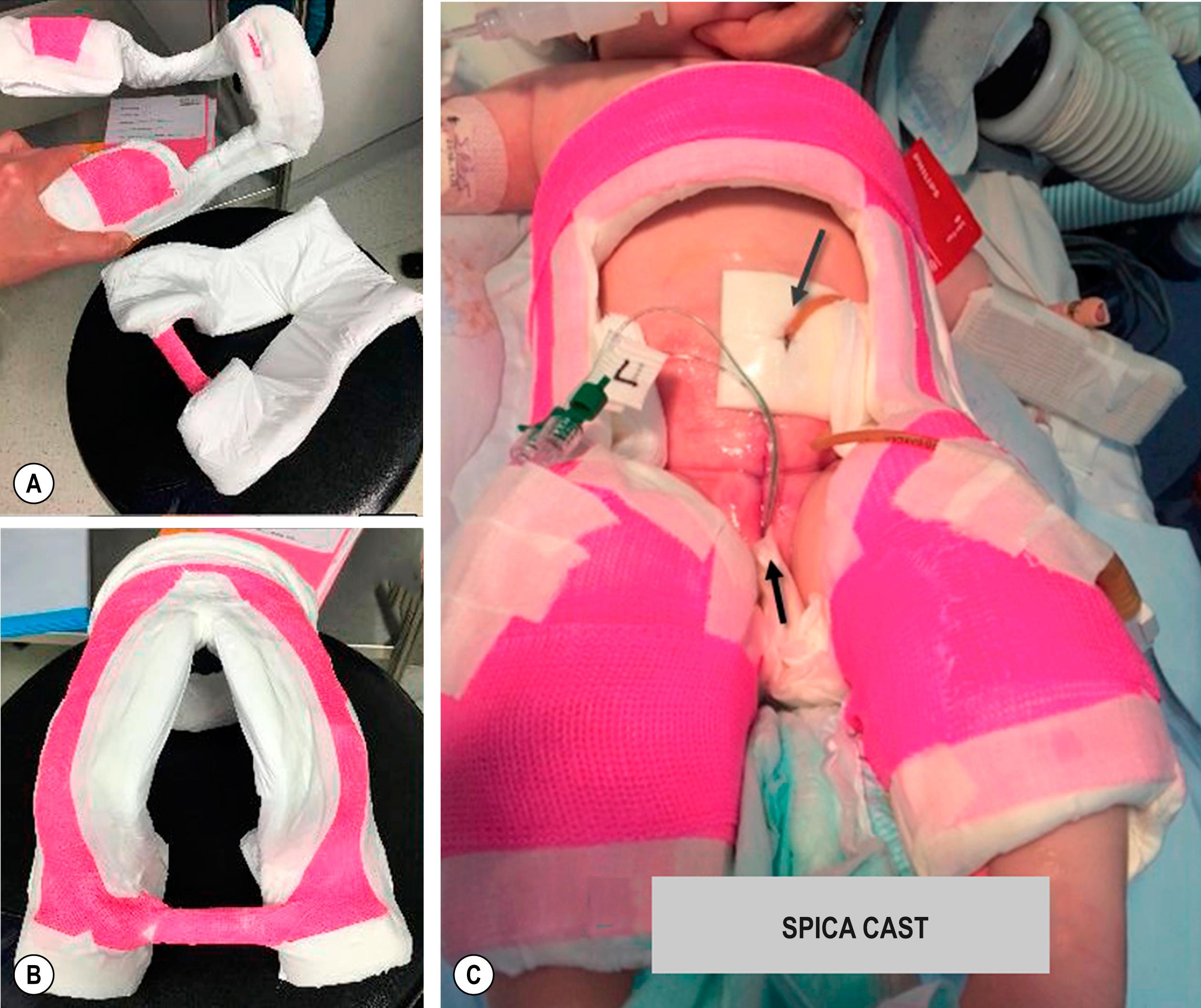 Fig. 58.1, The patient is immobilized after repair to prevent external hip rotation, to decrease lateral stresses on the closure, and to optimize pubic apposition in the early postoperative period. A number of immobilization techniques are possible. This photograph shows a hinged spica cast from anterior view (A) with a large section open to allow visualization of the abdomen. In the posterior view (B) , a section is open to provide access to the tunneled epidural site and to enable diaper changes. In (C) , note the suprapubic bladder catheter (long arrow), and two ureteral stents (short arrow) that act as a urethral catheter.