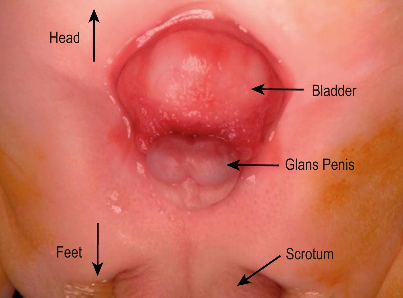 Fig. 58.2, The preoperative bladder exstrophy anatomy in a male is seen. Note the typical space between the ventral aspect of the penis and the cephalad extent of the scrotum.