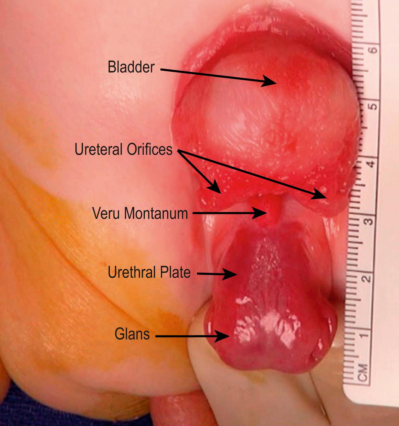 Fig. 58.3, The penis has been reflected ventrally to expose important anatomy and landmarks of the urethral plate, verumontanum, and ureteral orifices.