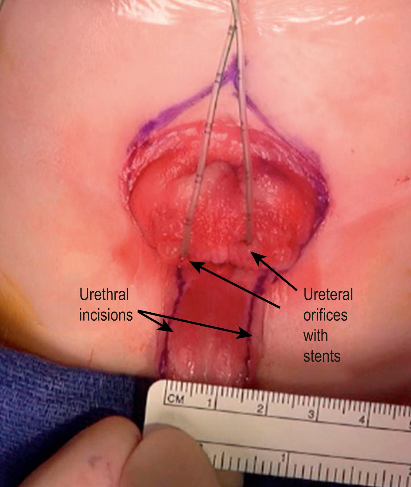 Fig. 58.4, The apex of the dissection has been marked along with the perimeter of the bladder and the longitudinal lines of incision along the urethral plate. Catheters have been inserted in the ureteral orifices.