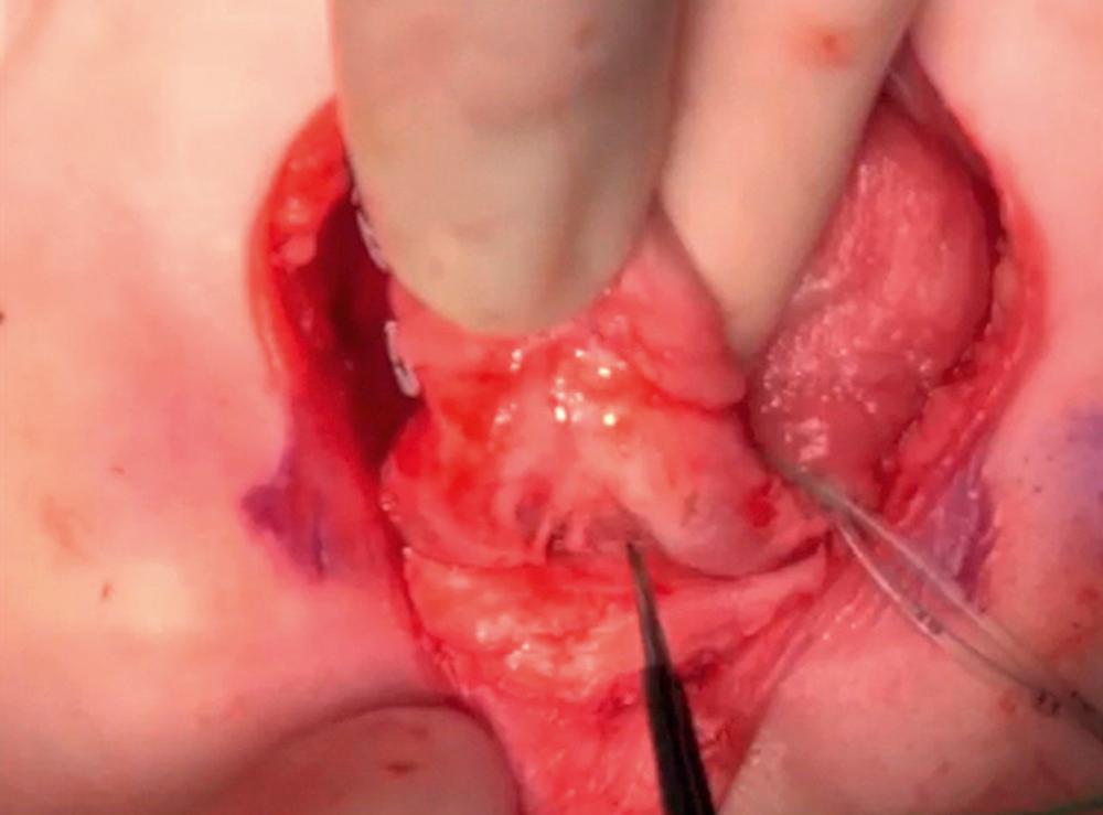 Fig. 58.5, The initial ventral approach to the urethral plate dissection is seen. Bipolar electrocautery through the micro-forceps is being used to dissect the corpora cavernosa off the corpus spongiosum.