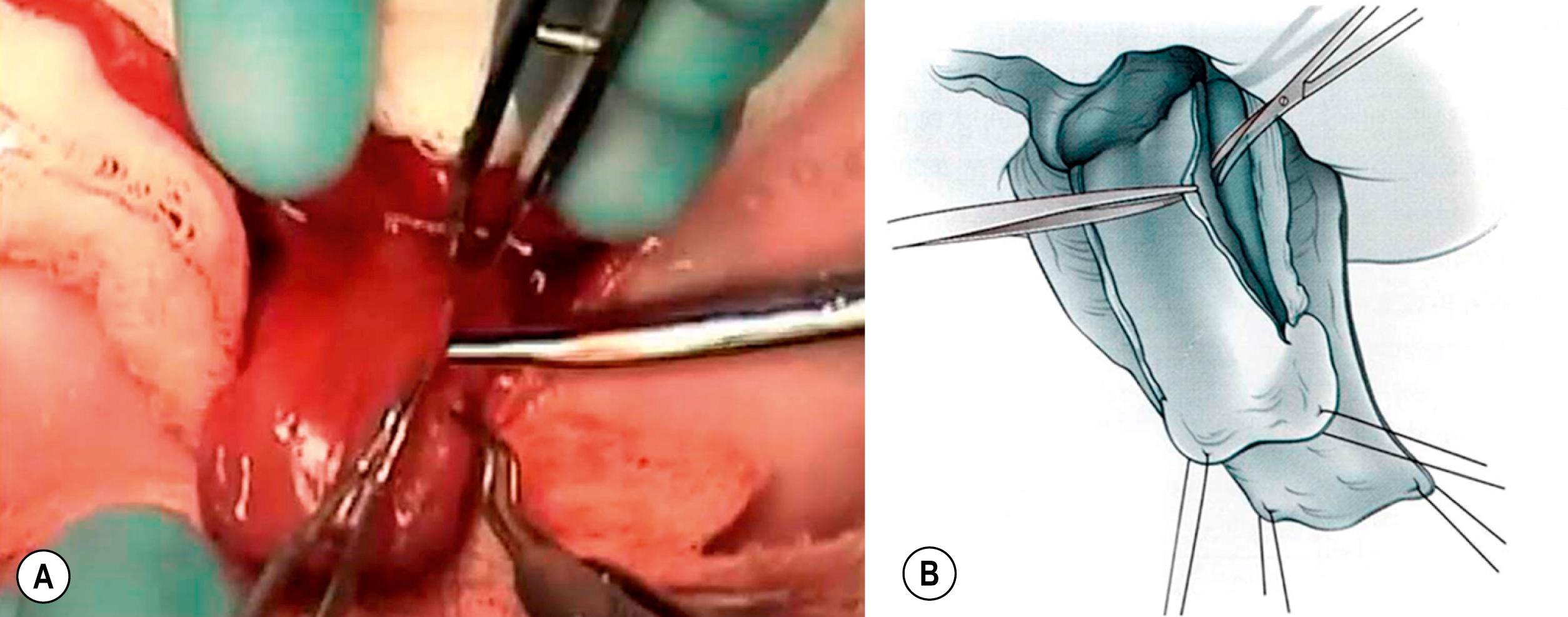 Fig. 58.6, This schematic (A) and operative photograph (B) depict the dorsal dissection of the urethral plate, separating the urethral plate off the corpora cavernosa.