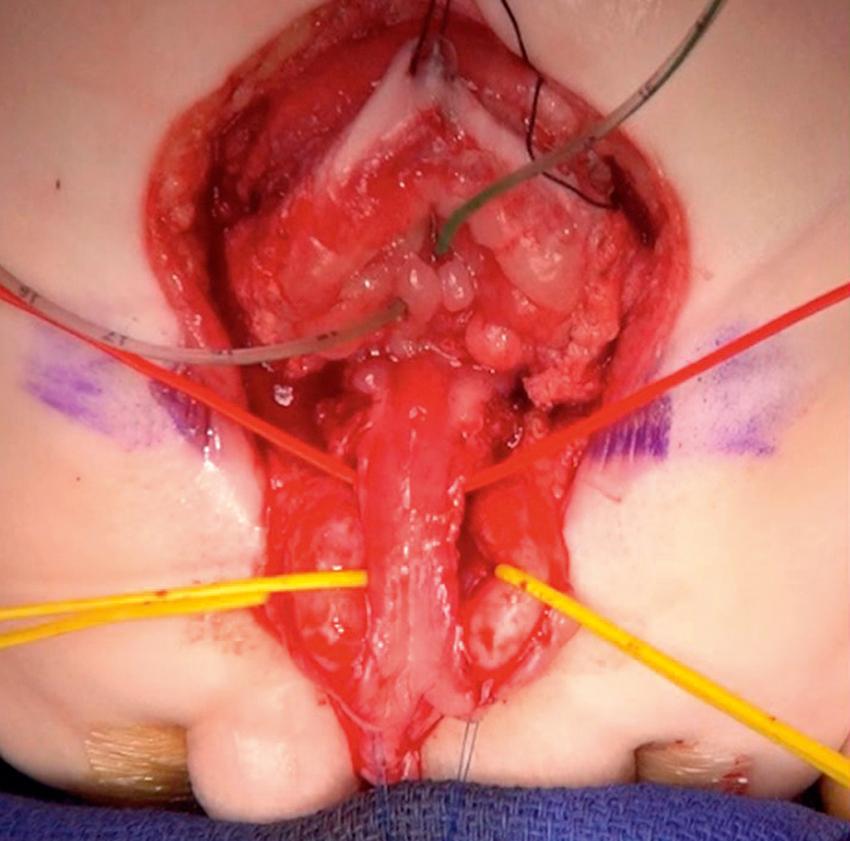 Fig. 58.7, The corpora cavernosa have been encircled with a yellow vessel loop bilaterally. The urethral plate has been elevated with red vessel loop. The anatomic dissection is complete.