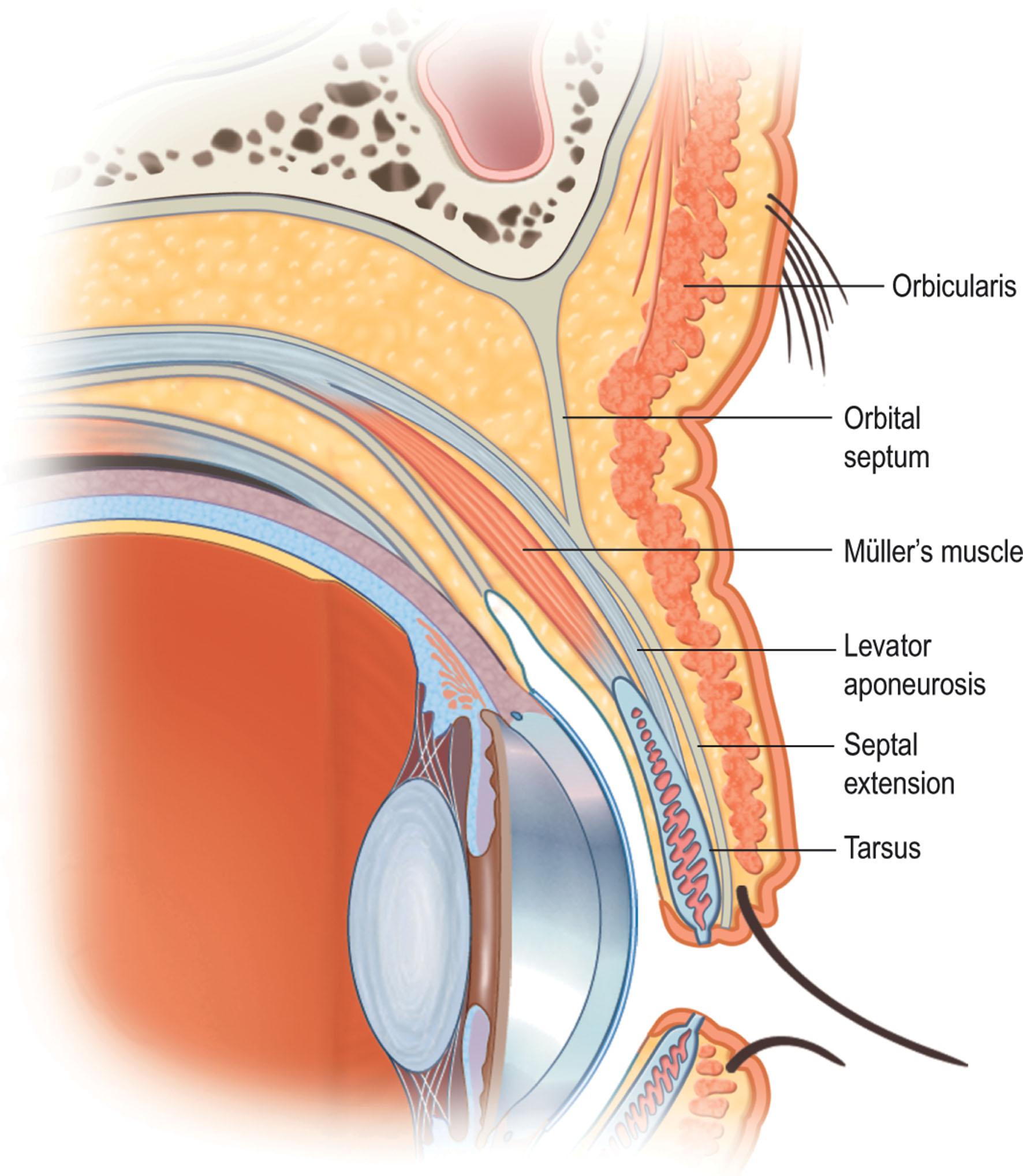 Figure 13.11, The orbital septum has an adhesion to the levator aponeurosis above the tarsus. The septal extension begins at the adhesion of the orbital septum to the levator and extends to the ciliary margin. It is superficial to the preaponeurotic fat found at the supratarsal crease.