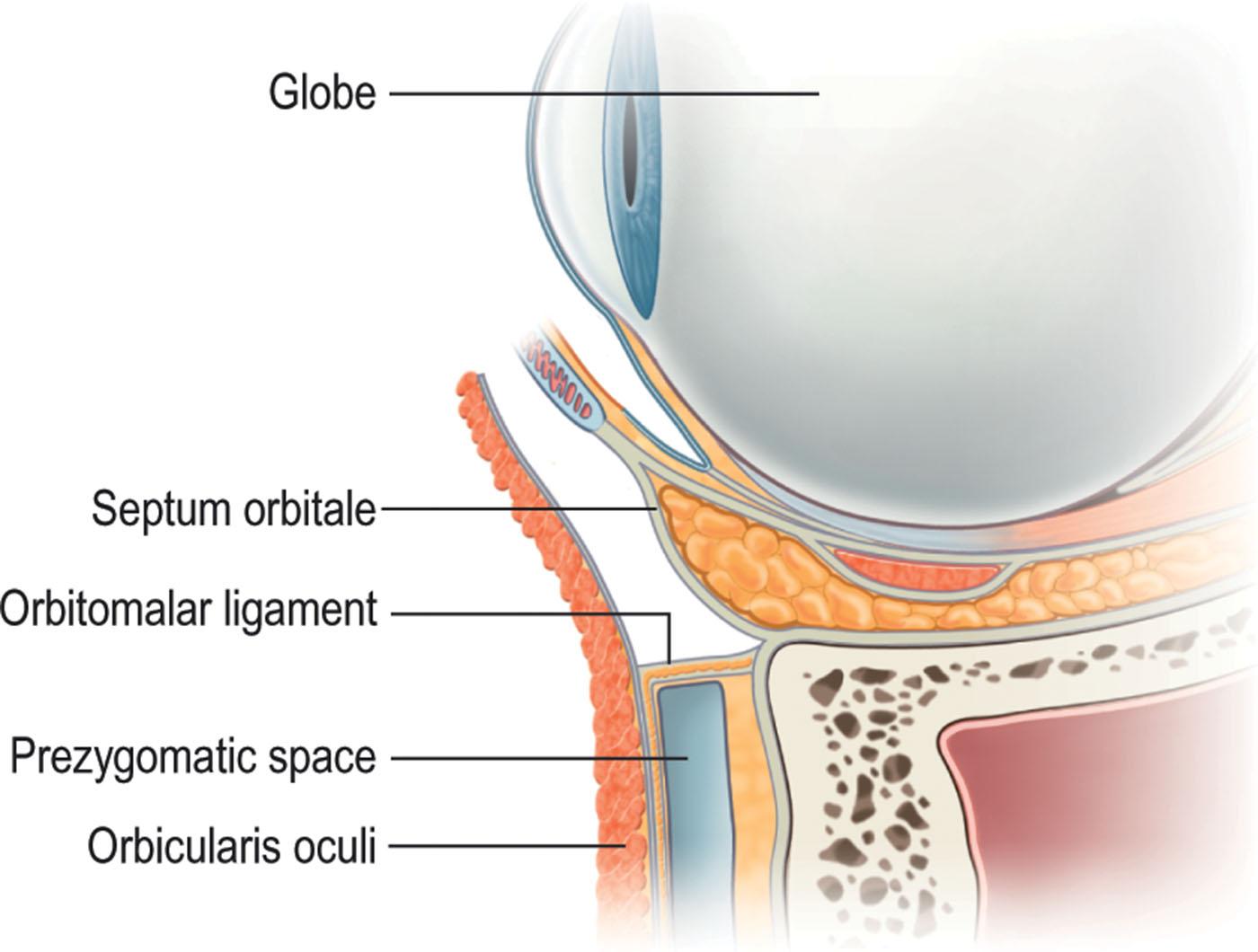 Figure 13.13, The orbital retaining ligament directly attaches the orbicularis oris at the junction of its pars palpebrarum and pars orbitalis to the periosteum of the orbital rim and, consequently, separates the prezygomatic space from the preseptal space.