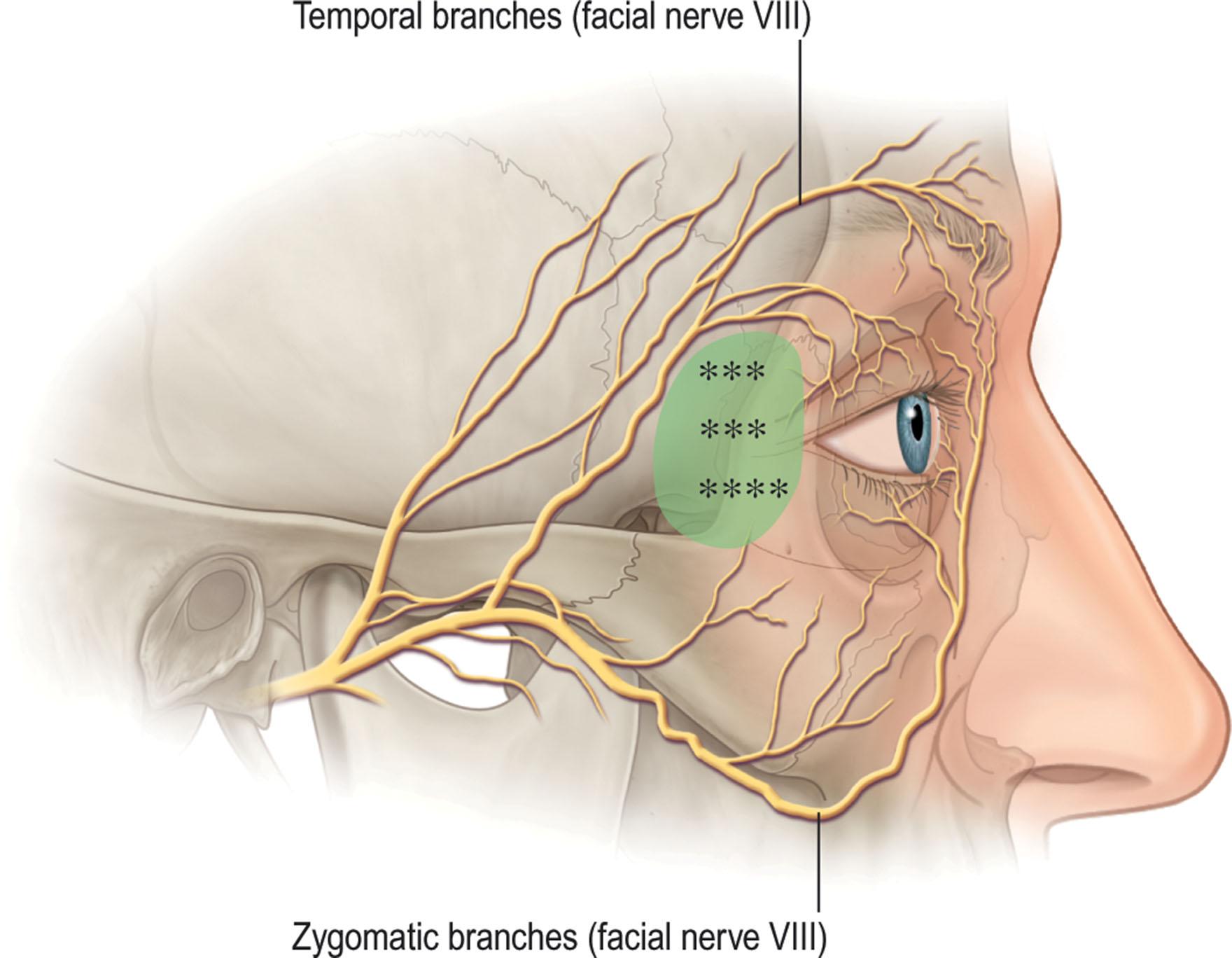 Figure 13.16, Anatomy of the brow and temporal region. The light green opaque area denotes the deep temporal fascia and the periosteum where sutures may be used to suspend soft tissue. Wide undermining, soft-tissue suspension, and canthopexy are safely performed here.