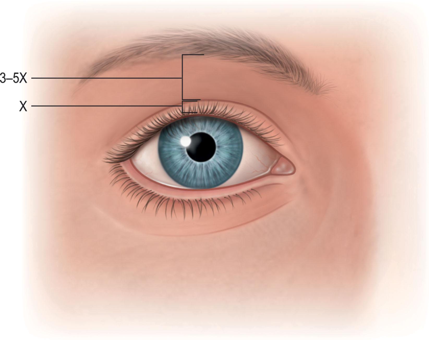 Figure 13.17, On relaxed forward gaze, the ideal upper lid should rest approximately 2 mm below the upper limbus. The lower lid ideally covers 0.5 mm of the lower limbus. The ratio of distance from the lower edge of the eyebrow to the open lid margin to the pretarsal skin ratio should be greater than 3.