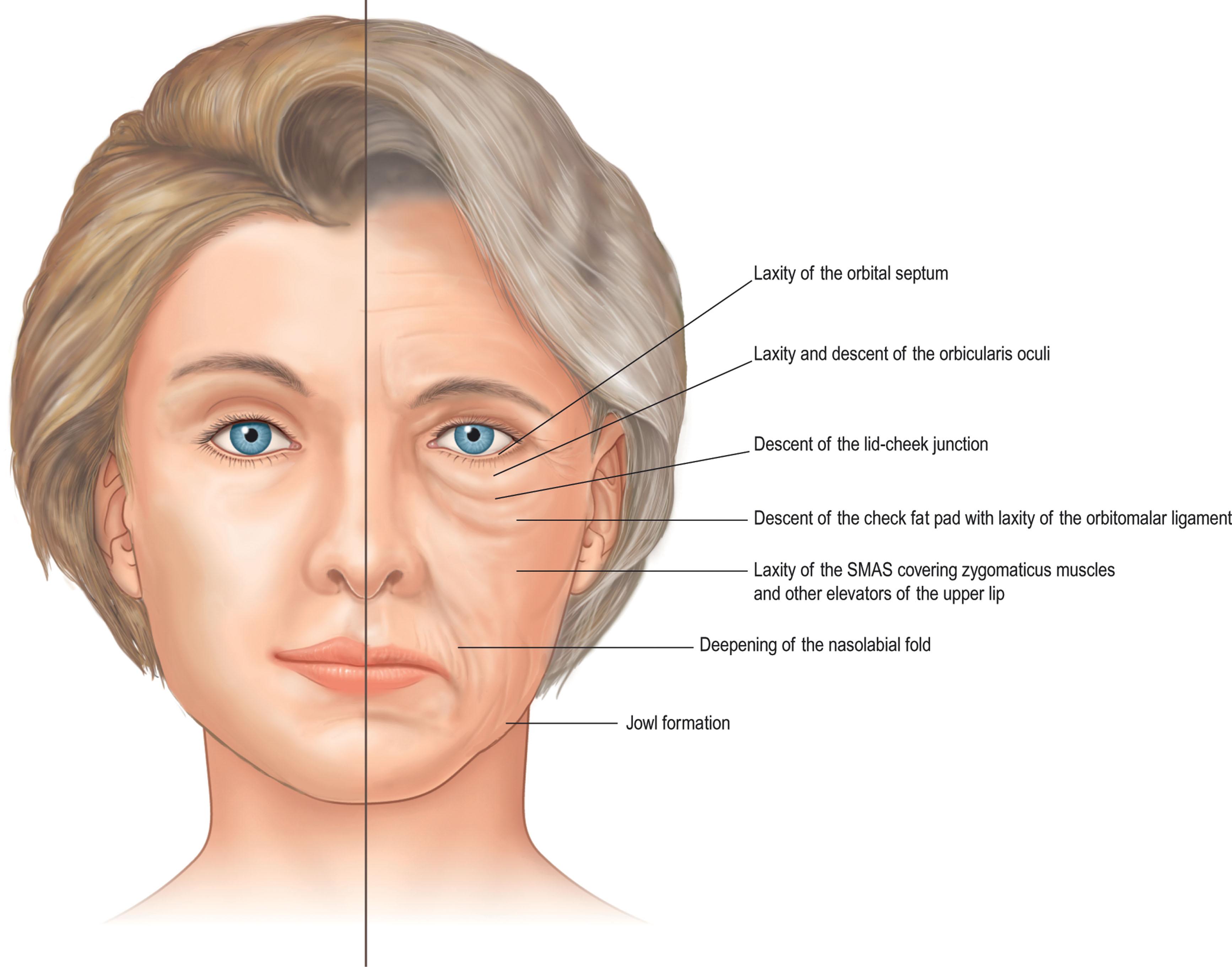 Figure 13.19, Midcheek deflation due to loss of superficial and deep fat. SMAS , Superficial musculoaponeurotic system.