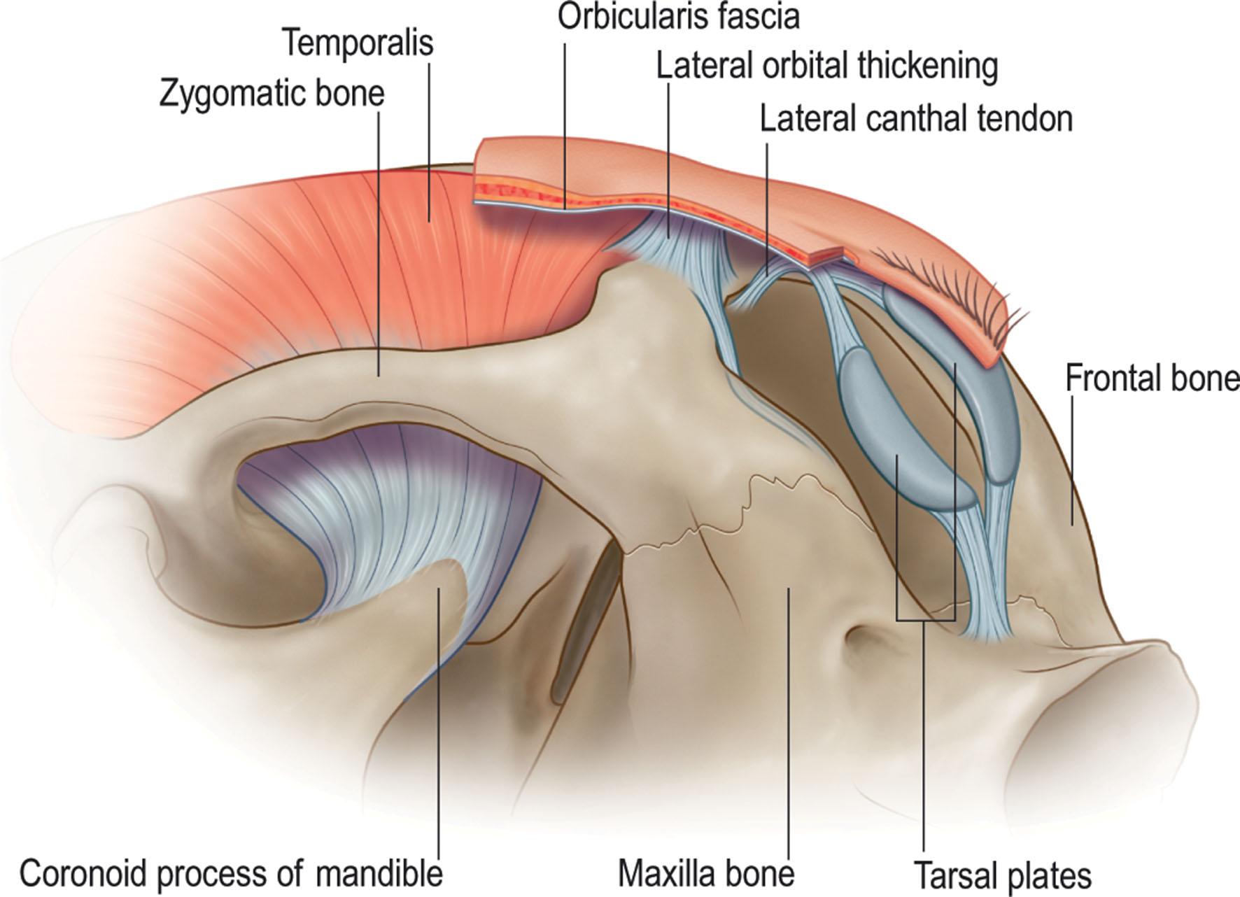 Figure 13.3, Lateral canthal tendon has separate superficial and deep components. The deep component attaches inside the orbital rim at Whitnall's tubercle. The superficial component passes from the tarsal plates to the periosteum of the lateral orbital rim and lateral orbital thickening. Both components are continuous with both superior and inferior lid tarsal plates.