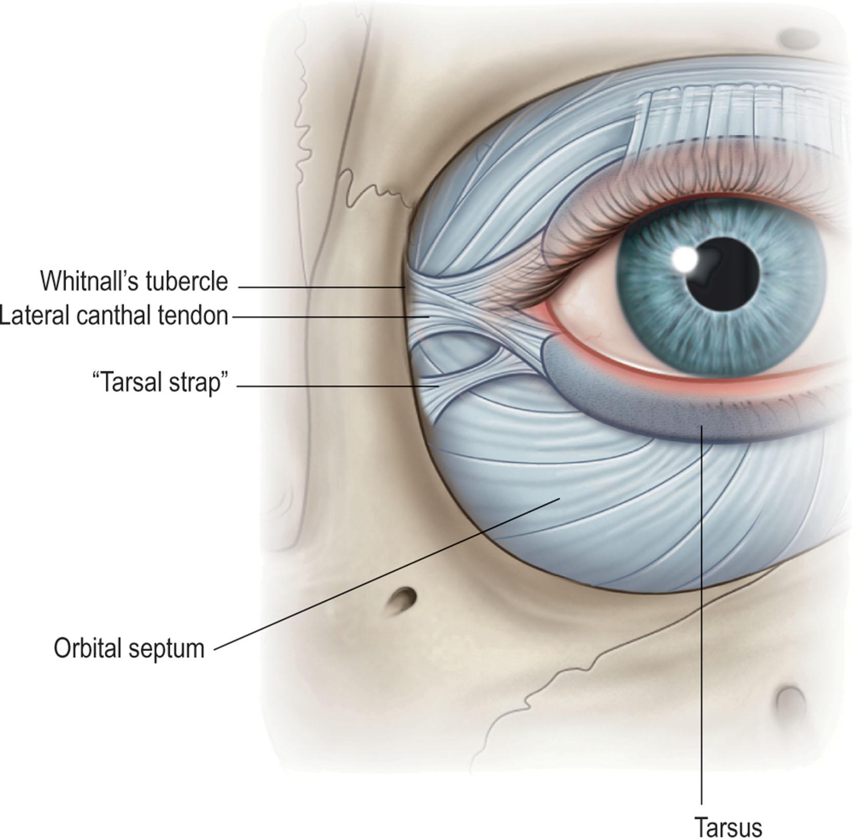 Figure 13.4, The deep portion of the lateral canthal tendon inserts securely into the thickened periosteum overlying Whitnall's tubercle. The tarsal strap is a distinct anatomic structure that suspends the tarsus medial and inferior to the lateral canthal tendon to the lateral orbital wall, approximately 4–5 mm from the orbital rim.