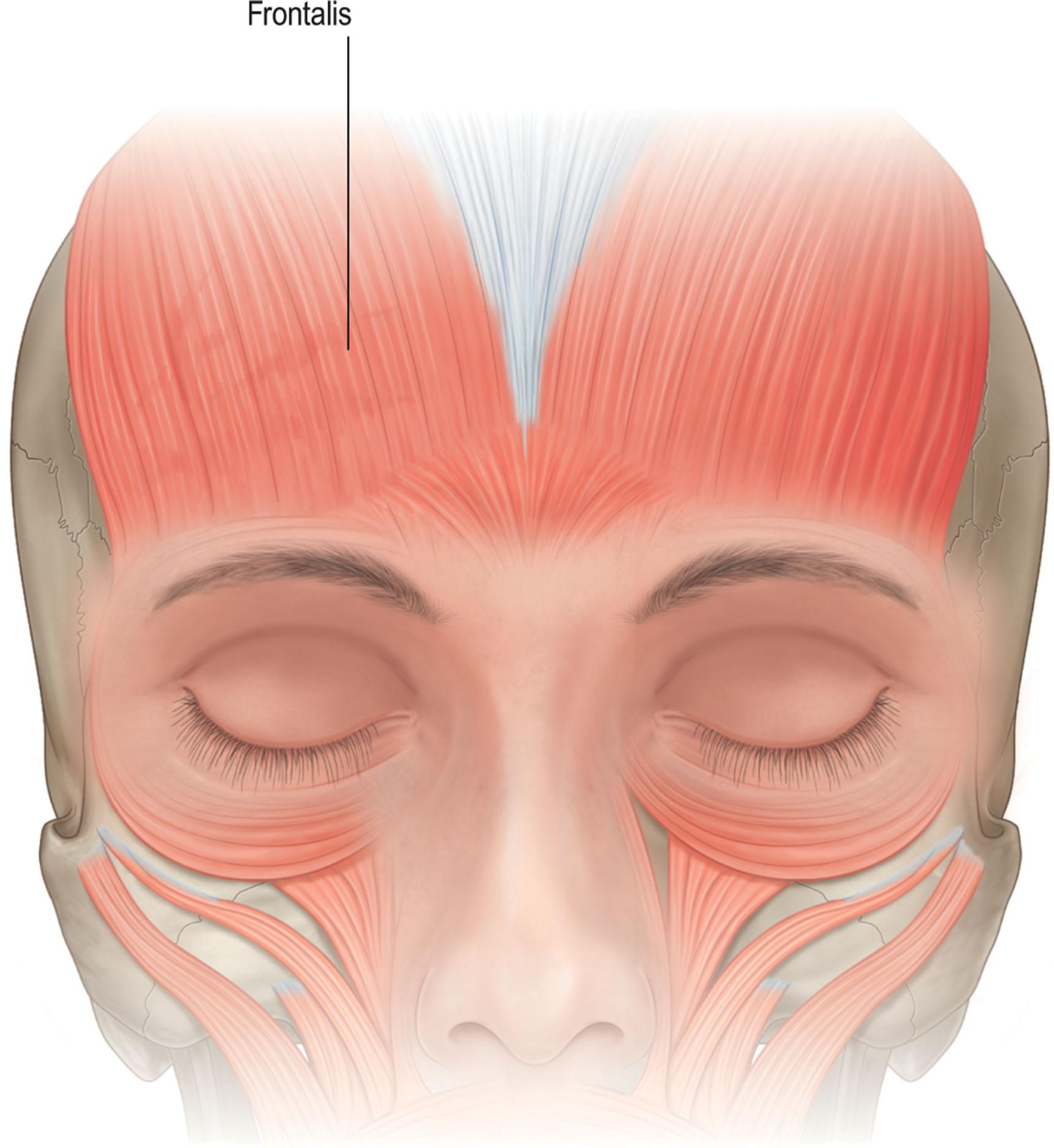 Figure 13.7, The frontalis muscle inserts predominantly into the medial half or two-thirds of the eyebrow. The medial brow responds to frontalis activation and elevates, often excessively, in its drive to clear lateral overhang.