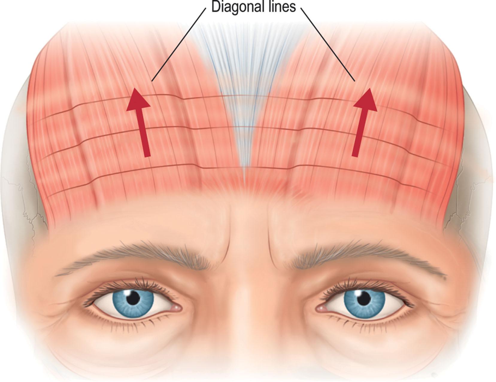 Figure 13.8, Frontalis action. The frontalis muscle inserts into the medial two-thirds of the brow. Exaggerated medial brow elevation is required to clear the lateral overhang and to eliminate visual obstruction. Constant contraction of the frontalis will give the appearance of deep horizontal creases in the forehead. This necessarily means that when the lateral skin is elevated or excised, the over-elevated and distorted medial brow drops profoundly.