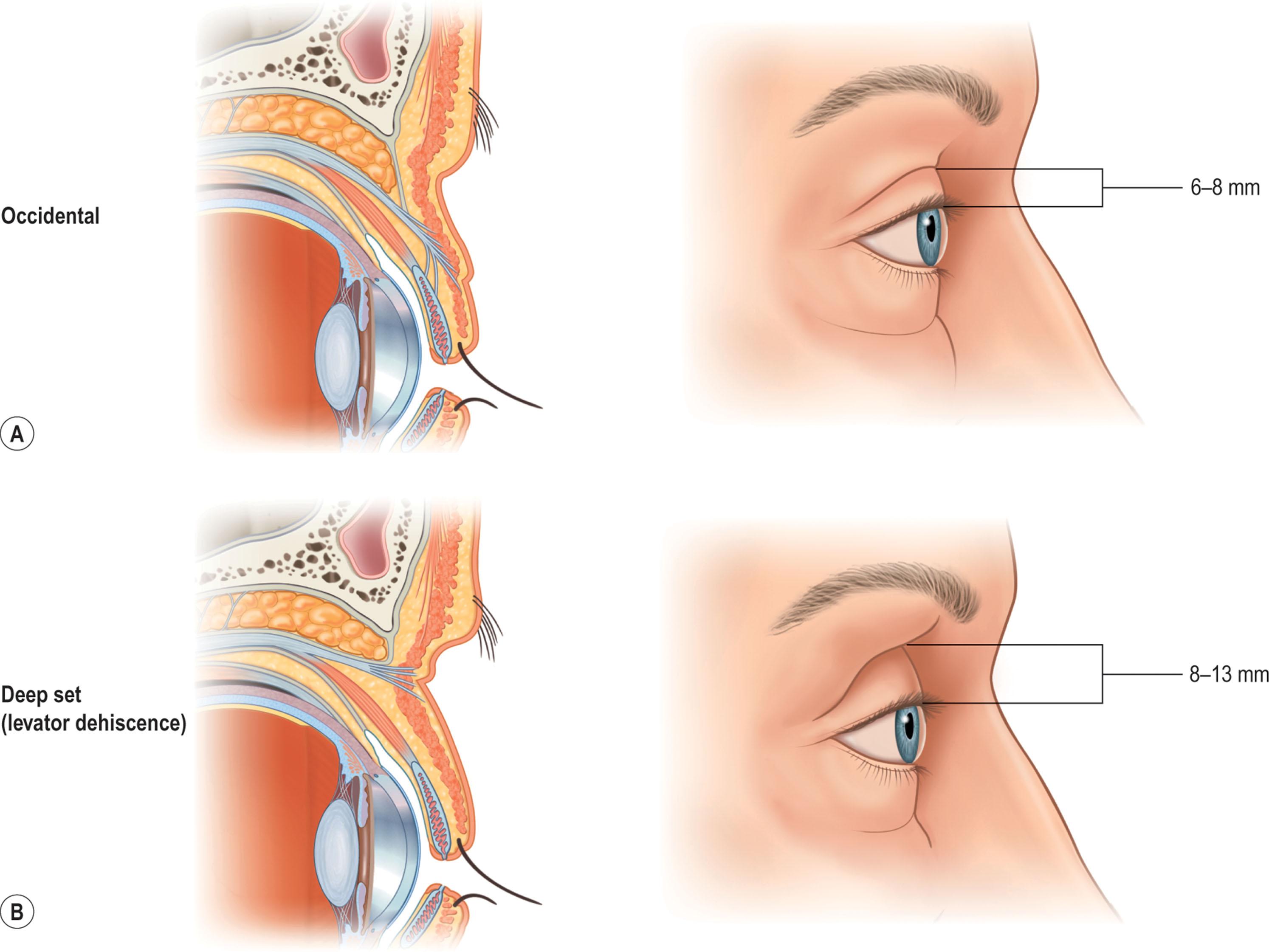 Figure 13.10, The anatomic variations in the upper eyelid displayed by different ethnic groups and the changes associated with senescence within each group allow for a convergence of anatomy. (A) In European ethnicities, the upper eyelid has levator extensions inserting onto the skin surface to define a lid fold that averages 6–8 mm above the lid margin. The position of the levator–skin linkage and the anteroposterior relationship of the preaponeurotic fat determine lid fold height and degree of sulcus concavity or convexity (as shown on the right half of each anatomic depiction). (B) In the case of levator dehiscence from the tarsal plate, the upper lid crease is displaced superiorly. The orbital septum and preaponeurotic fat linked to the levator are displaced superiorly and posteriorly. These anatomic changes create a high lid crease, a deep superior sulcus, and eyelid ptosis. (C) In the aging eyelid, the septum becomes attenuated and stretches. The septal extension loosens which allows orbital fat to prolapse forward and slide over the levator into an anterior and inferior position. Clinically, this results in an inferior displacement of the levator–skin attachments and a low and anterior position of the preaponeurotic fat pad. (D) The youthful Asian eyelid anatomically resembles the senescent upper lid with a low levator–skin zone of adhesion and inferior and anteriorly located preaponeurotic fat. The characteristic, but variable, low eyelid crease and convex upper eyelid and sulcus are classic.