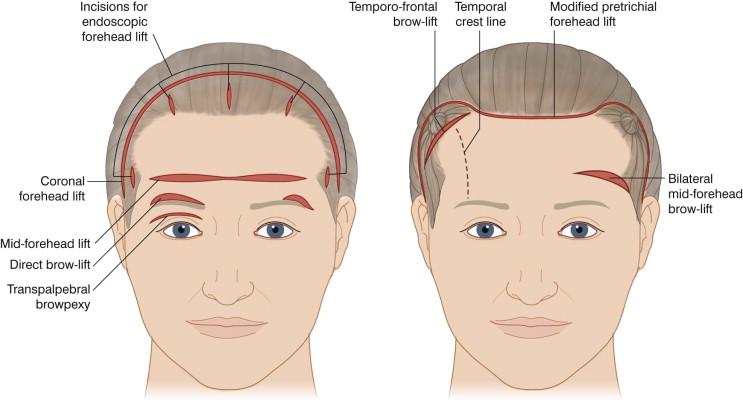 FIGURE 40.12, Traditional surgical approaches to brow-lift.