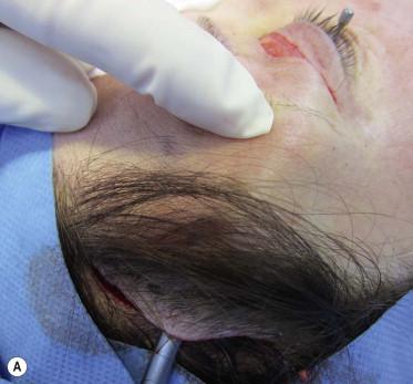 FIGURE 40.17, Temporo-frontal brow-lift, intraoperative views. (A) Using a Ramirez no.4 dissector first the temporal pocket is prepared just superficial to the deep temporal fascia and is carried out inferomedially down to the orbital rim. (B) A bridge of subcutaneous tissue containing the neurovascular bundle should be carefully preserved between the temporal and frontal portion of the incision. (C) Suture fixation from the superficial to the deep temporal fascia, the lifting of the lateral eyebrow is achieved.