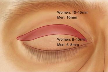 FIGURE 40.18, Skin markings for upper blepharoplasty. In women the upper eyelid crease is placed 8–10 mm above the lash line and 10–15 mm below the lower margin of the brow. The excision is planned to achieve placement of the incision scar into the upper eyelid crease.