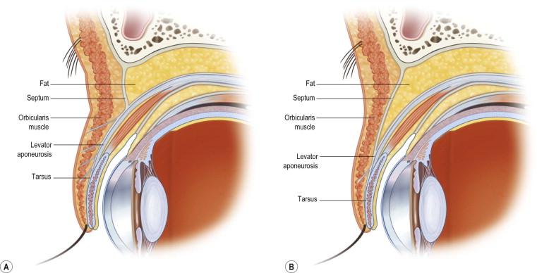 FIGURE 40.4, Cross-sectional anatomy of the upper eyelid. (A) In non-Hispanic white and some Asian patients, the levator aponeurosis penetrates the pretarsal orbicularis oculi muscle and inserts into the dermis, which accounts for the presence of a supratarsal upper eyelid fold. (B) In Asians the levator aponeurosis does not insert into the dermis. This is supposedly the reason for both the creaseless aspect of the Asian upper eyelid and also the puffiness due to the descent of the central orbital fat pad more inferiorly than in the non-Hispanic white eye.