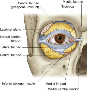 FIGURE 40.5, Upper and lower eyelid fat pads and tendons.