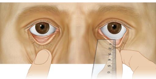 FIGURE 40.8, The snap-back and distraction tests, utilized to assess lower eyelid tone.