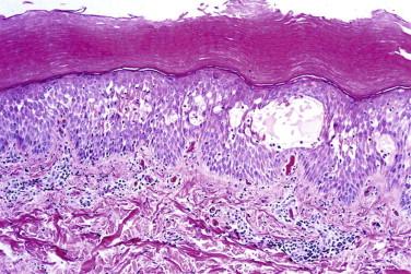 FIGURE 5-1, Spongiotic blister. Edema separates keratinocytes, many of which are still connected to each other via intercellular bridges.