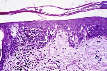 FIGURE 5-11, Pemphigus vulgaris. Early lesion with eosinophilic spongiosis and acantholysis.