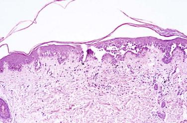 FIGURE 5-12, Pemphigus vulgaris. Suprabasilar acantholytic blister.