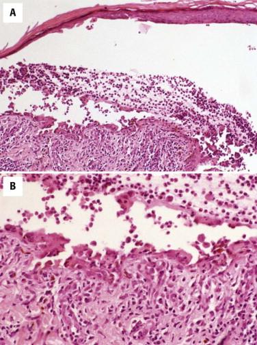 FIGURE 5-13, Pemphigus vulgaris. A, Suprabasilar acantholytic blister cavity with inflammatory cells. B, Polymorphonuclear cells predominate.