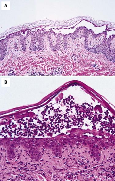 FIGURE 5-16, Pemphigus foliaceus. A, Subcorneal split. B, Subcorneal aggregates of neutrophils.