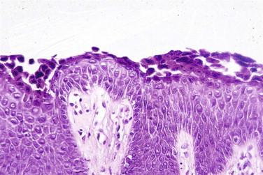 FIGURE 5-17, Pemphigus foliaceus. Acantholysis in the granular cell layer with “missing” stratum corneum.