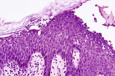 FIGURE 5-18, Pemphigus foliaceus. Neutrophils in the granular cell layer.