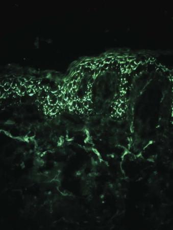 FIGURE 5-19, Pemphigus foliaceus. Direct immunofluorescence shows deposits of IgG on the surface of keratinocytes of the upper epidermis.