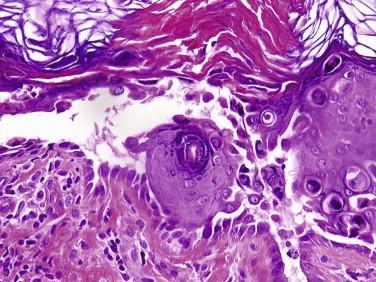 FIGURE 5-2, Acantholytic blister. Loss of cell adhesion between keratinocytes has led to a change in their cell shape from polygonal to round or oval. Intercellular bridges are lost.