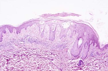 FIGURE 5-3, Intraepidermal blister. Acute spongiotic dermatitis with multiple fluid-filled spaces within the epidermis.