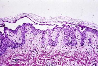 FIGURE 5-4, Intraepidermal blister. Acantholytic subcorneal blister with split underneath the granular cell layer.