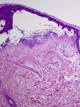 FIGURE 5-5, Subepidermal blister. The epidermis is lifted up and separated from the dermis, creating a blister cavity. The basal cell layer of the epidermis forms the bottom of the blister roof.