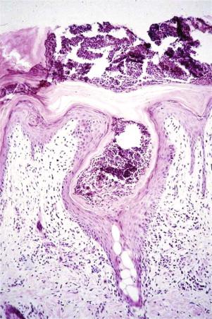 FIGURE 5-6, Miliaria. Subcorneal pustule involving the ostium of the eccrine duct.