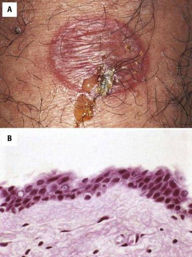 FIGURE 5-7, Staphylococcal scalded skin syndrome. A, Flaccid blister. B, The stratum corneum is separated from the epidermis. There is no inflammation.