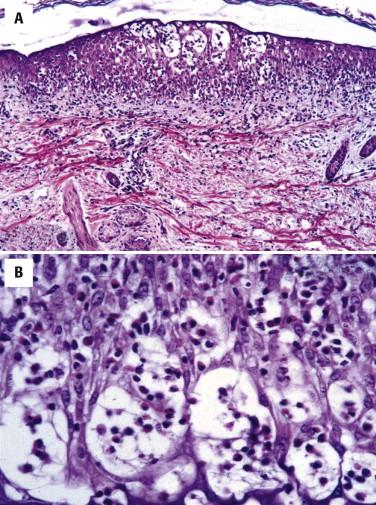 FIGURE 5-9, Incontinentia pigmenti. A, Microvesicles within the epidermis. B, Eosinophilic spongiosis.