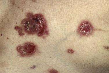 FIGURE 5-10, Pemphigus. Multiple erosions are present after rupture of flaccid blisters.