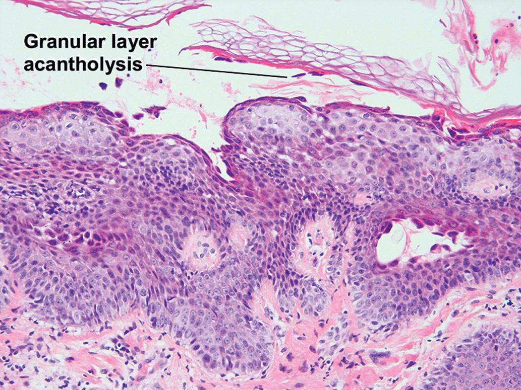 Fig. 9.1, Pemphigus foliaceus