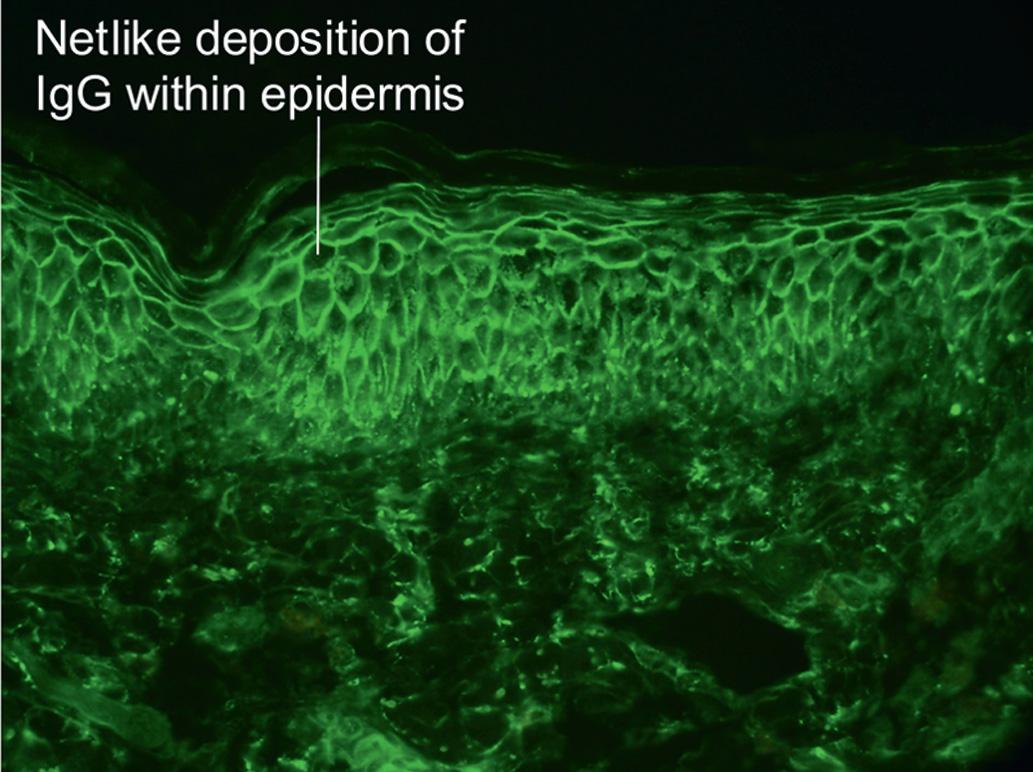 Fig. 9.2, Direct immunofluorescence of “netlike” staining in the upper epidermis of pemphigus foliaceus