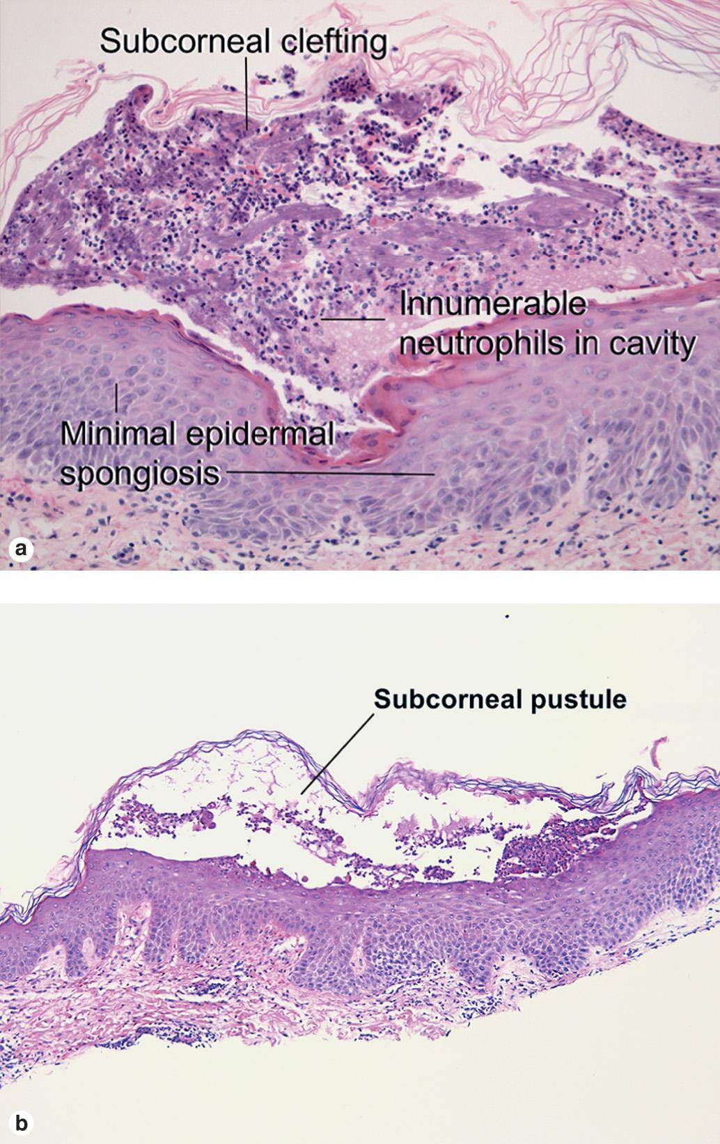 Fig. 9.3, (A) Subcorneal pustular dermatosis. (B) “Subcorneal pustular dermatosis” type of IgA pemphigus