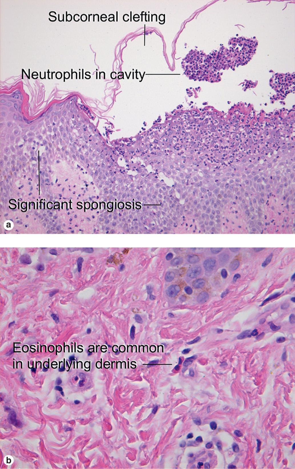 Fig. 9.4, Acute generalized exanthematous pustulosis