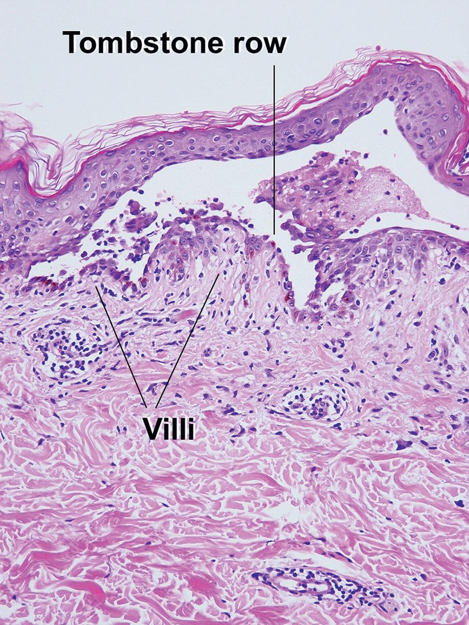 Fig. 9.5, Pemphigus vulgaris