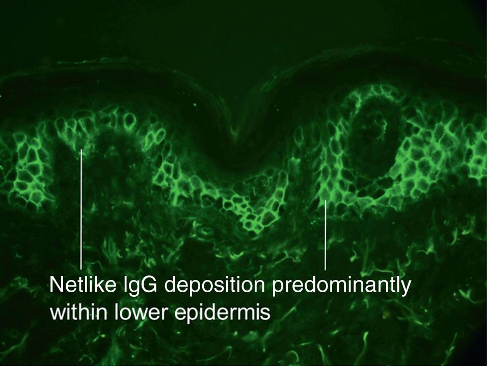 Fig. 9.6, Direct immunofluorescence of pemphigus vulgaris