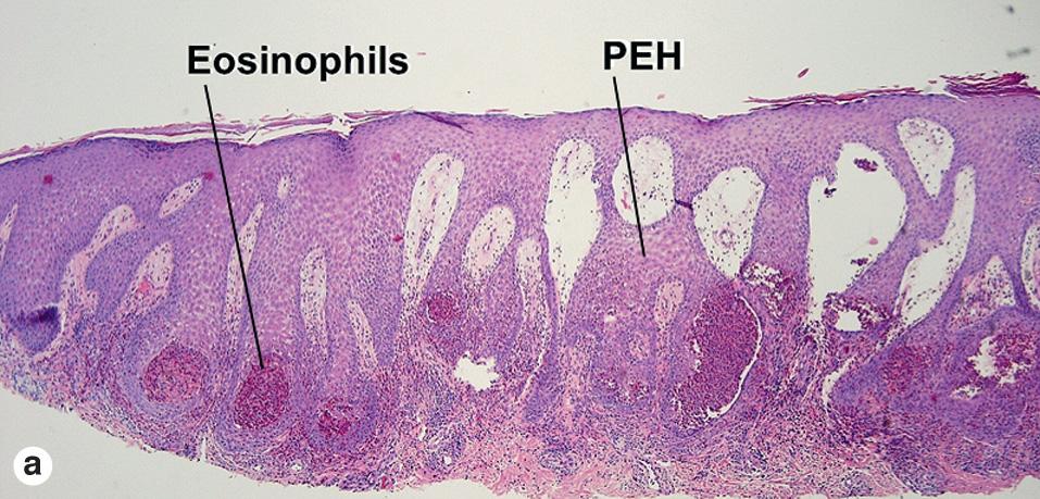 Fig. 9.7, Pemphigus vegetans–pseudoepitheliomatous hyperplasia (PEH) and eosinophils