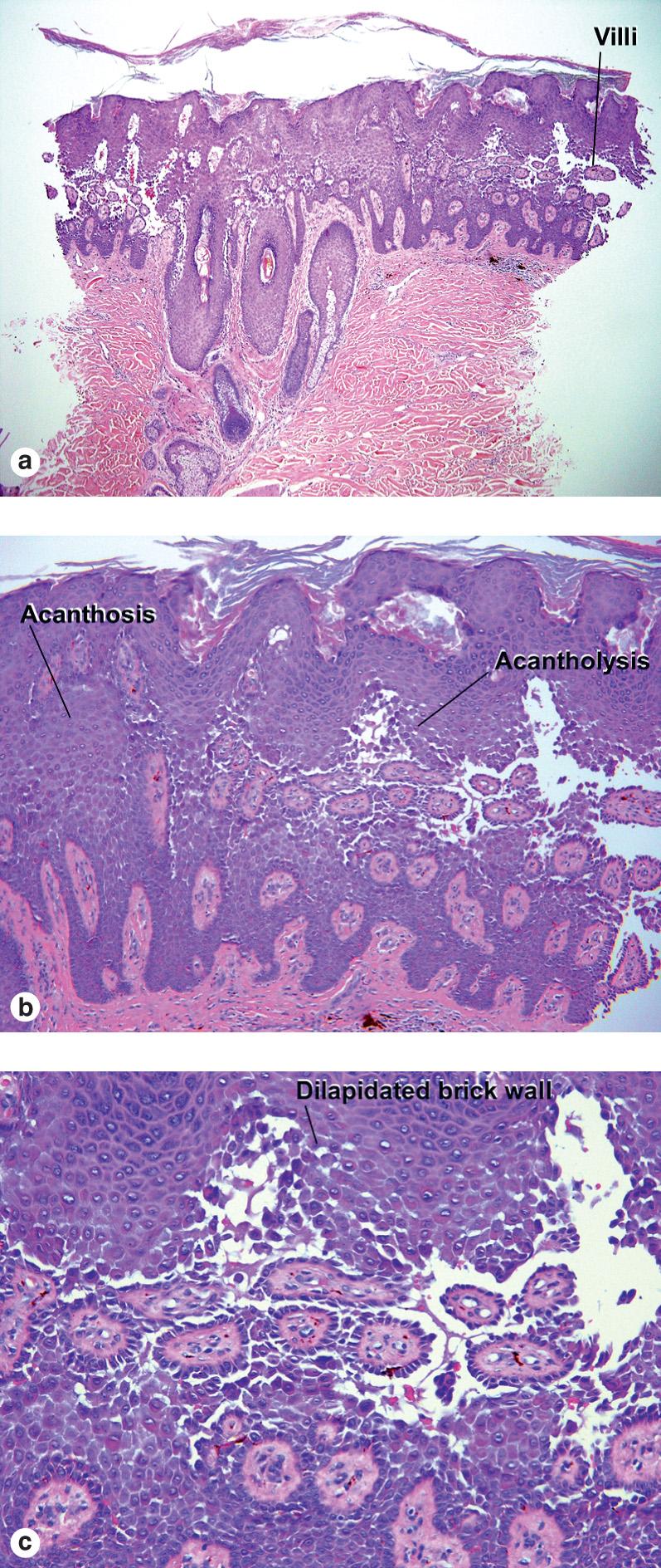 Fig. 9.8, Hailey–Hailey disease