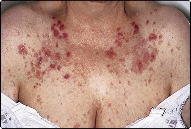 Fig. 44.2, Pemphigus foliaceus showing blisters and erosions on the chest.