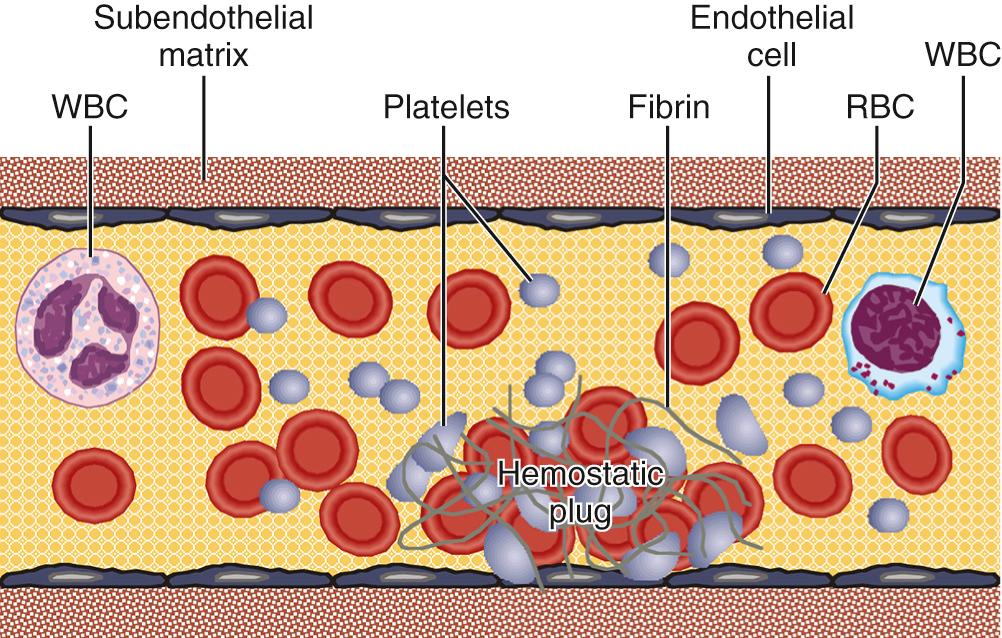 FIGURE 51-1, Hemostasis is the prevention of blood loss; it is accomplished by vasoconstriction and coagulation by cellular and coagulation factors. Undue bleeding is controlled, and the fluidity of the blood is maintained by counterbalances within the coagulation and fibrinolytic systems. Blood vessel injury or disruption, platelet defects, abnormalities of the normally circulating anticoagulants, and fibrinolytic mechanisms can upset the balance between fibrinolysis and coagulation. Blood normally circulates through endothelium-lined vessels without coagulation or platelet activation occurring and without appreciable hemorrhage. Injury to the endothelial cells triggers the hemostatic process, which begins with tissue factor liberation, exposed subendothelial proteins such as collagen, the attachment of platelets (adhesion) to the damaged endothelium or via a von Willebrand factor bridge to allow platelet attachment. The platelets then change form (i.e., activate) and release factors that stimulate the clotting process. They also bind together (i.e., aggregate). At the same time, plasma proteins can react with elements in the subendothelium, activating the contact phase of coagulation. Exposed fibroblasts and macrophages present tissue factor, a membrane protein, to the blood at the injured site, thereby triggering the extrinsic phase of blood coagulation. Under normal conditions, hemostasis protects the individual from massive bleeding secondary to trauma. In abnormal states, life-threatening bleeding can occur or thrombosis can occlude the vascular tree. Hemostasis is influenced by a number of different factors including: (a) vascular extracellular matrix and alterations in endothelial reactivity, (b) platelets, (c) coagulation proteins, (d) inhibitors of coagulation, and (e) fibrinolysis. RBC, Red blood cell; WBC, white blood cell.