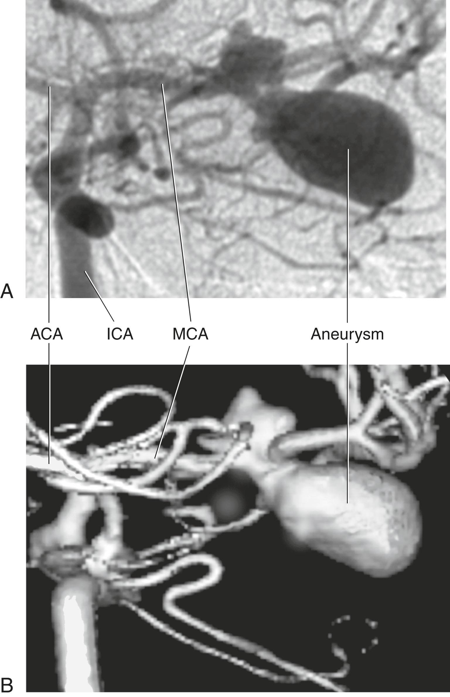 Fig. 4.8, (A) Excerpt from a conventional carotid angiogram, antero-posterior view, showing an aneurysm attached to the middle cerebral artery. (B) Excerpt from a three-dimensional image of the same area. ACA , Anterior cerebral artery; ICA , internal carotid artery; MCA , middle cerebral artery.